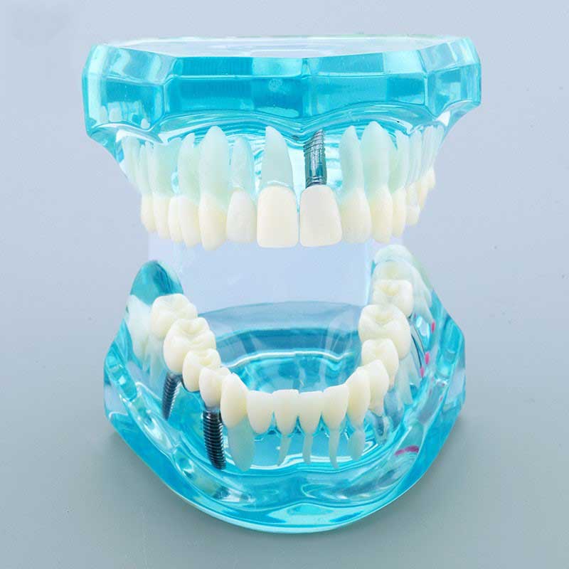 Dental Study Tooth Pathological Model