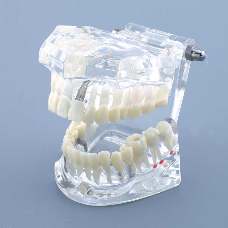 Dental Study Tooth Pathological Model
