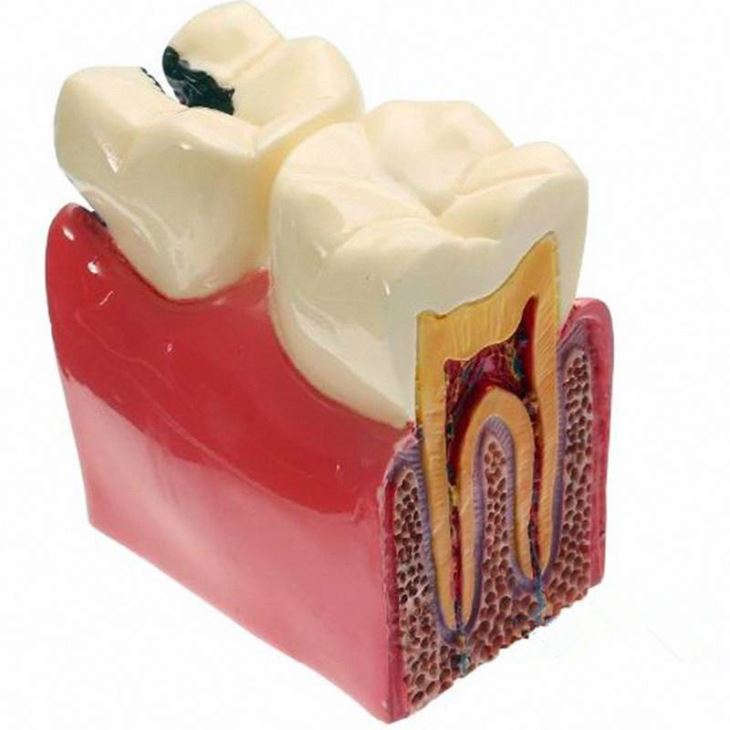 6 Times Caries Comparation Study Model