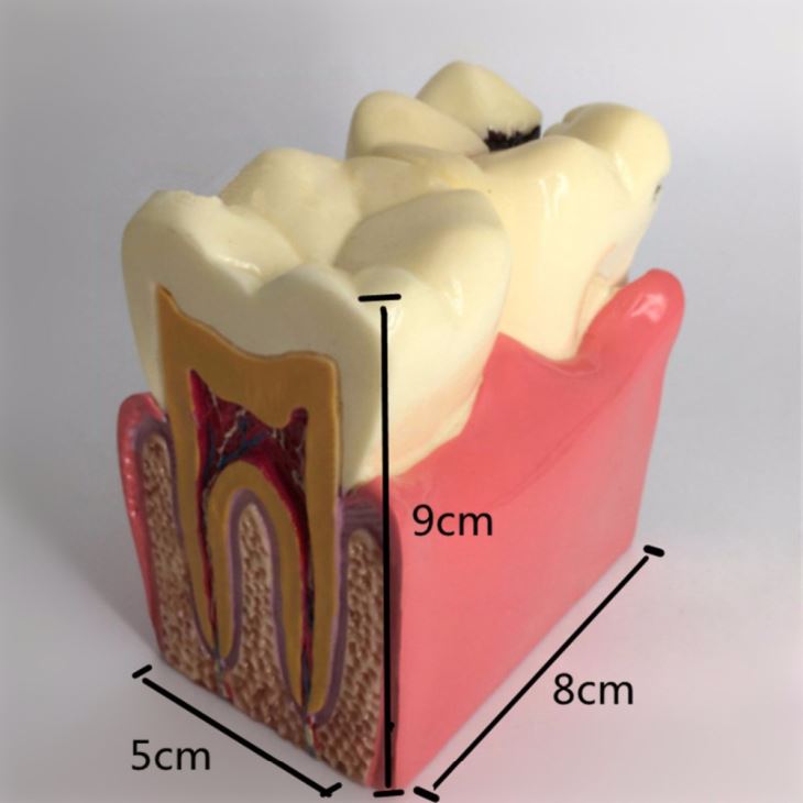 6 Times Caries Comparation Study Model
