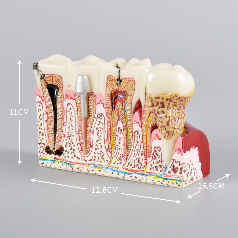 Dental Pathology Model
